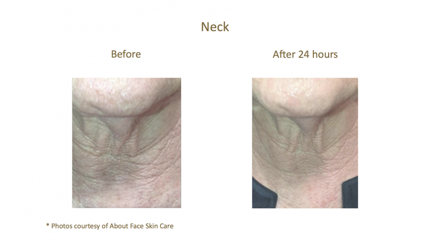 Before and after with AquaGold Fine Touch treatment in Dubai Before and after with AquaGold Fine Touch treatment in Dubai